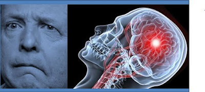 Faktor Resiko Stroke & Cara Mencegah Penyakit Stroke Gb. Faktor Resiko Stroke & Cara Mencegah Penyakit Stroke