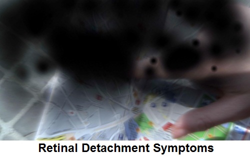 detached retina symptoms pictures detached retina symptoms pictures