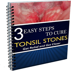 Tonsil stones removal Free ebook