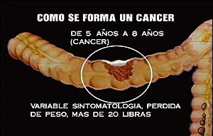 Secuencia de imágenes de como se forma un cáncer.