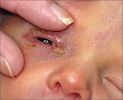 Sipilis Di anak Sipilis Di anak