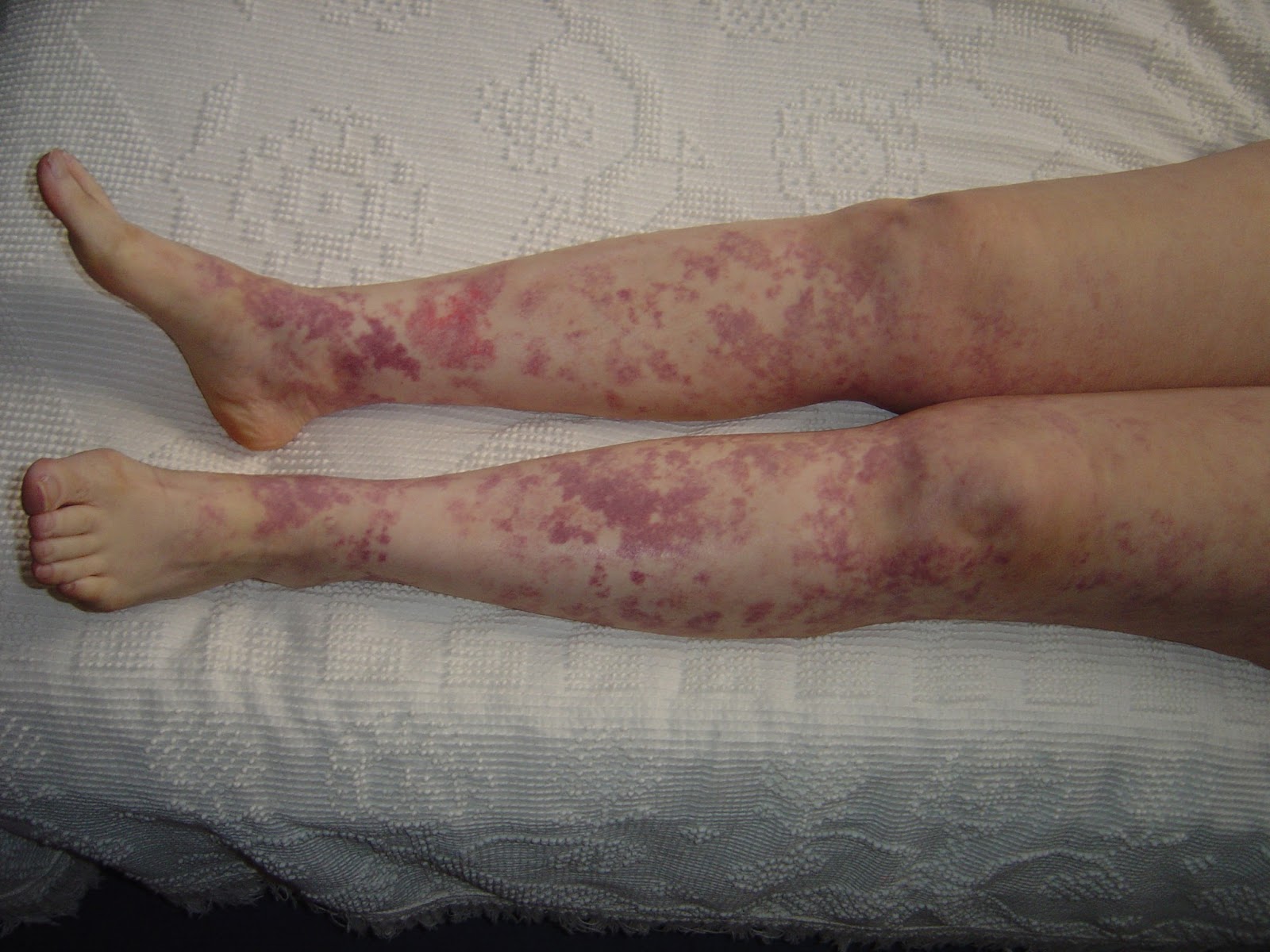 My Legs with rash from vitamins