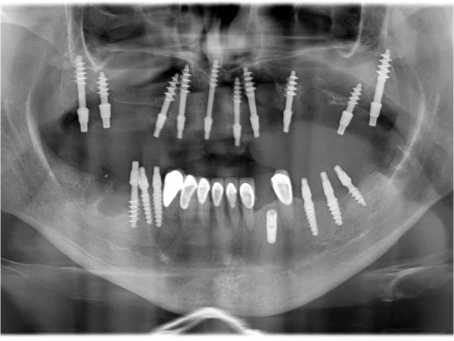 FULL UPPER ARCH DENTAL IMPLANTS COST IN INDIA