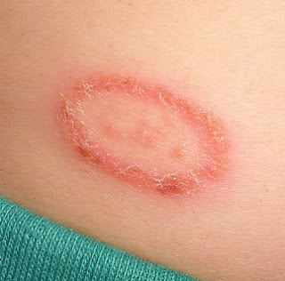 Home Cure For Ringworm