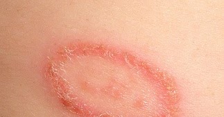 Home Cure For Ringworm - Ringworm