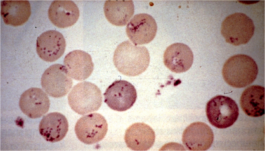 BARTONELLA DENTRO DE HEMATIES