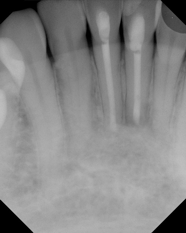 The Endo Blog Success with endodontic surgery (apicoectomy)
