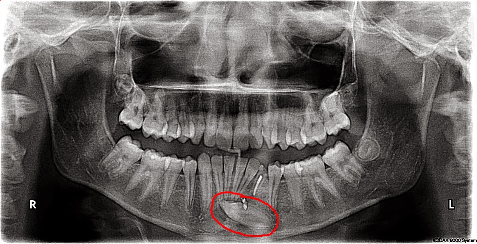 Blog Why XRays are VERY important.