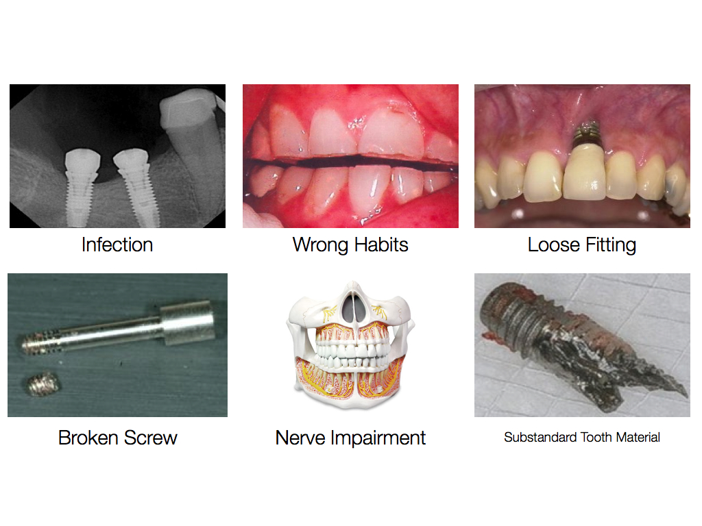 Formosa Dent. Work of "Difference between Natural Teeth and Implants."