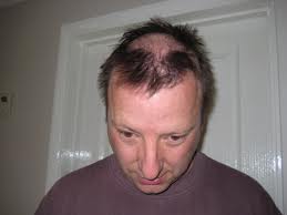 Vitamin E for Hair Loss and Skin Problems | ArganRain ...