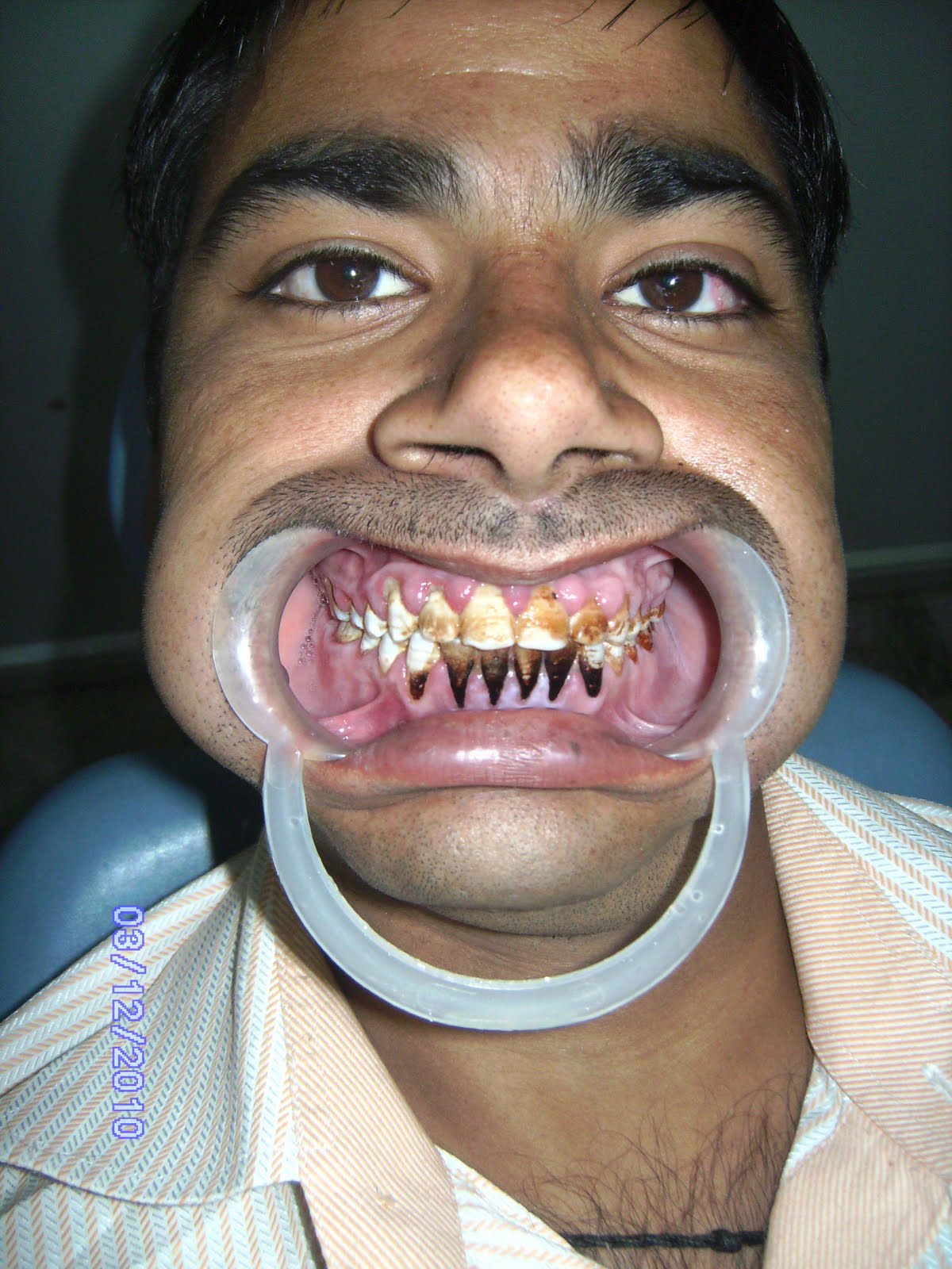 oral medicine and radiology soft tissue changes in disease