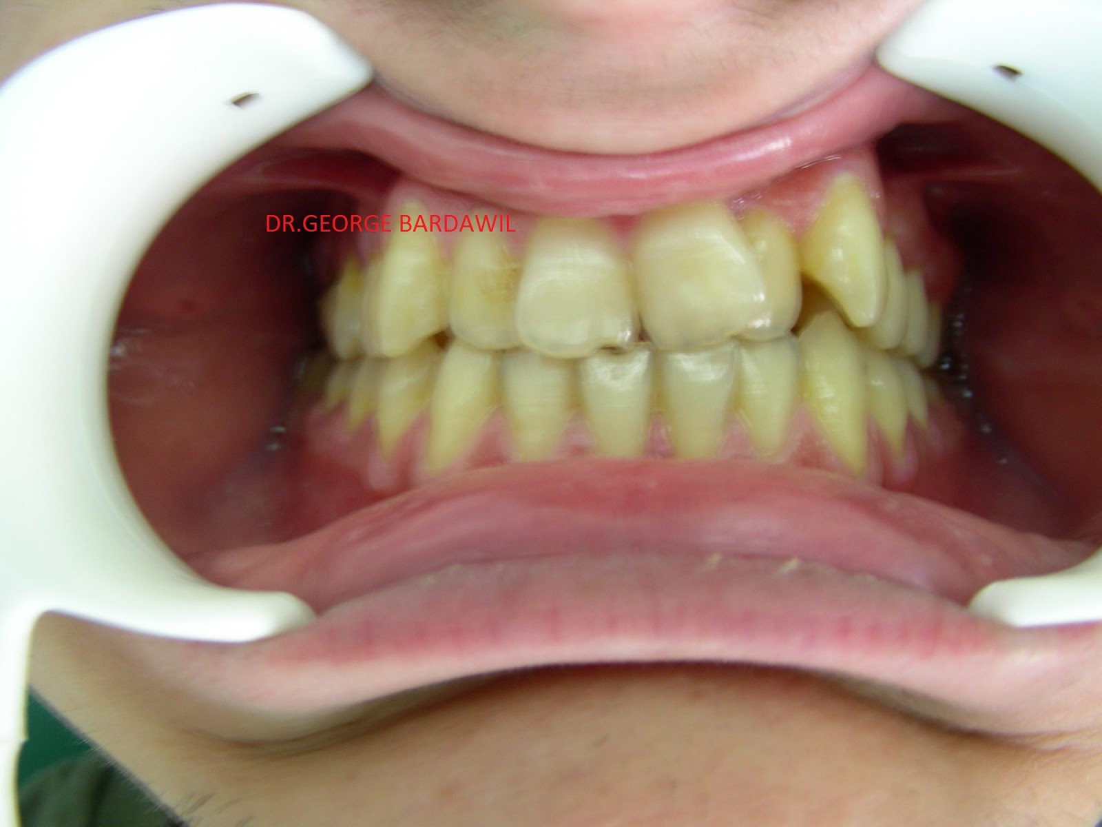 E. BardawilOrthodontistInvisalign Diamond level Anterior