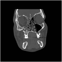 Radiologist For Ever: Face rule 1 : Zygomatico-maxillary ...