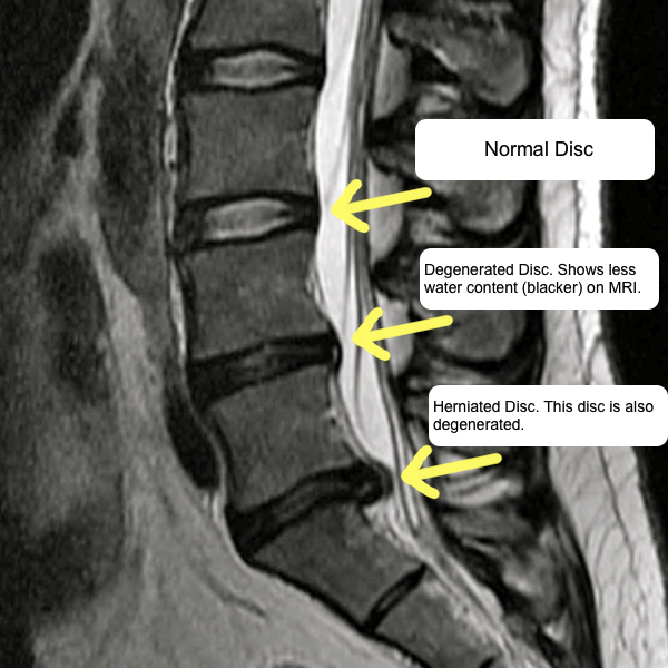Degenerative Disc Disease