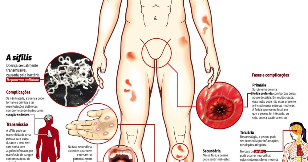 Resultado de imagem para sifilis