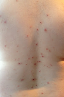 Varicella case study nursing image