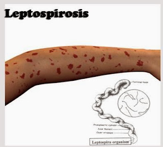 Penyakit Leptospirosis Penyakit Leptospirosis