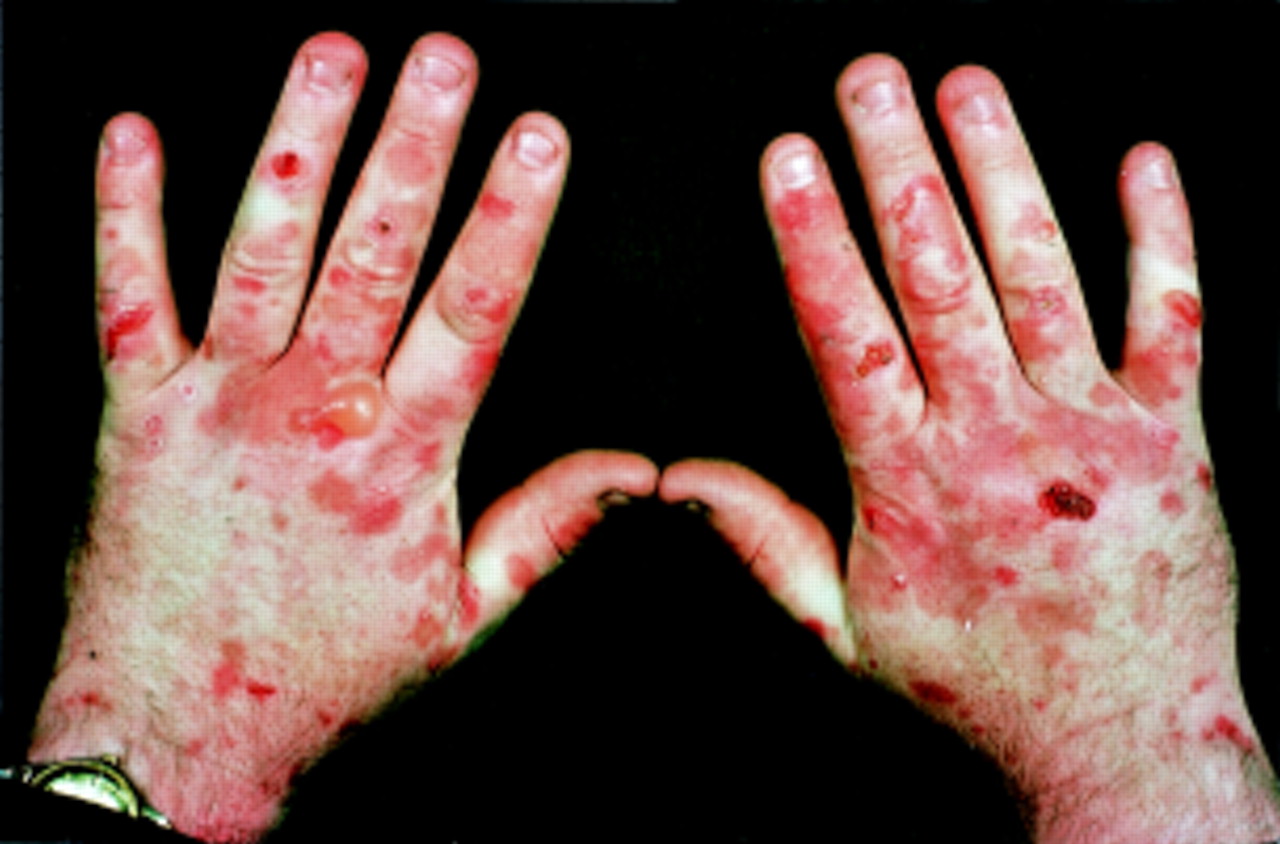 Dracula Myth or Reality: Porphyria: The Vampire Disease