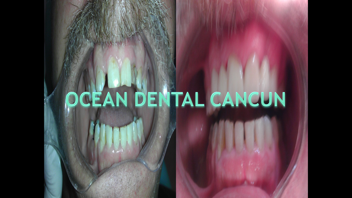 Ocean Dental Cancun