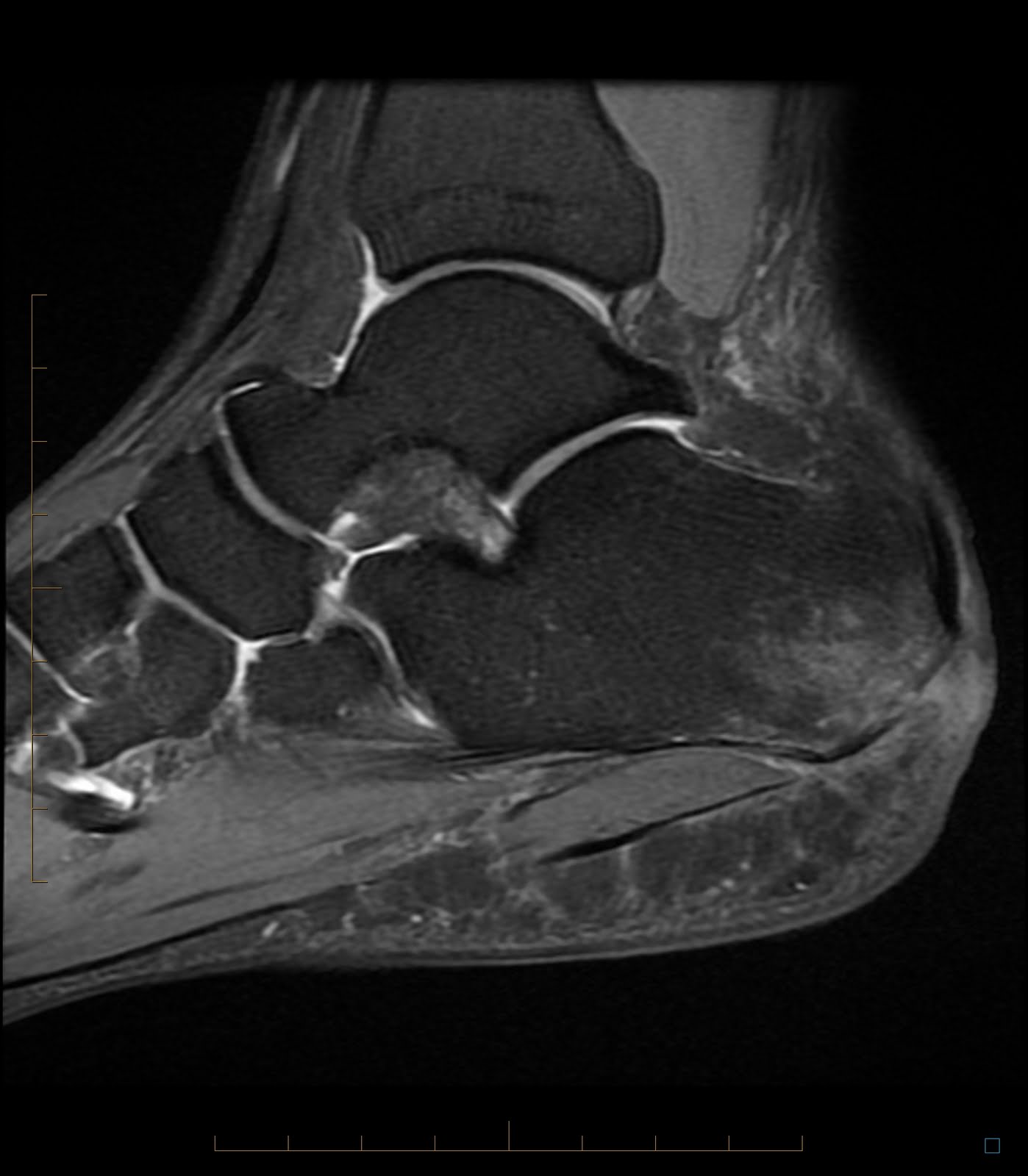 Radiology Cases Calcaneal Osteomyelitis