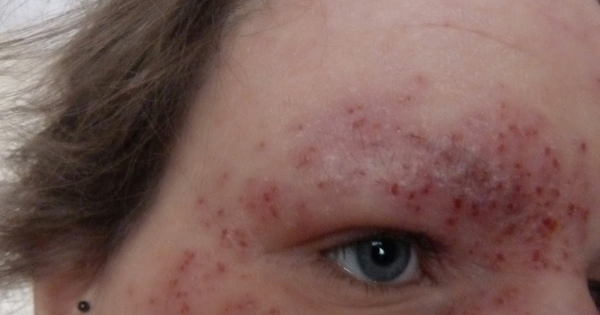 I Have Eczema Eczema Herpeticum No. 9 Cont.