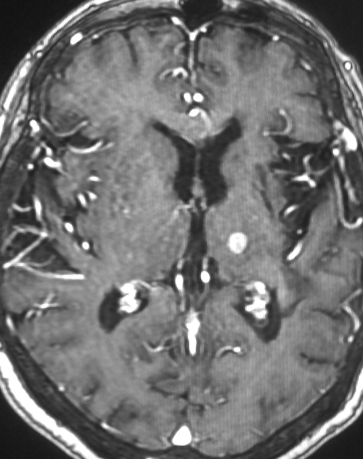 Thalamic Haemorrhage
