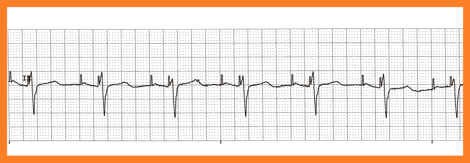 Practice EKG Strips 313