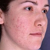 Beauty and skin care bad-skin-with-acne