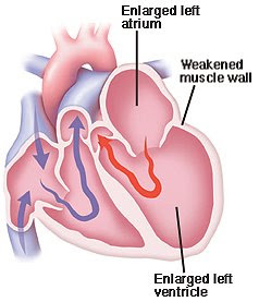 dilated cardiomyopathy | picture of heart disease | heart dilated picture