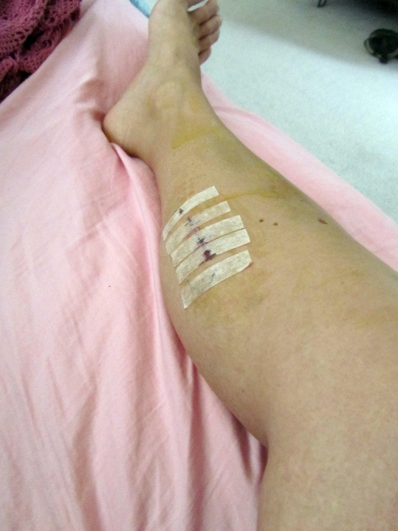 symptoms of compartment syndrome in lower leg symptoms of compartment syndrome in lower leg