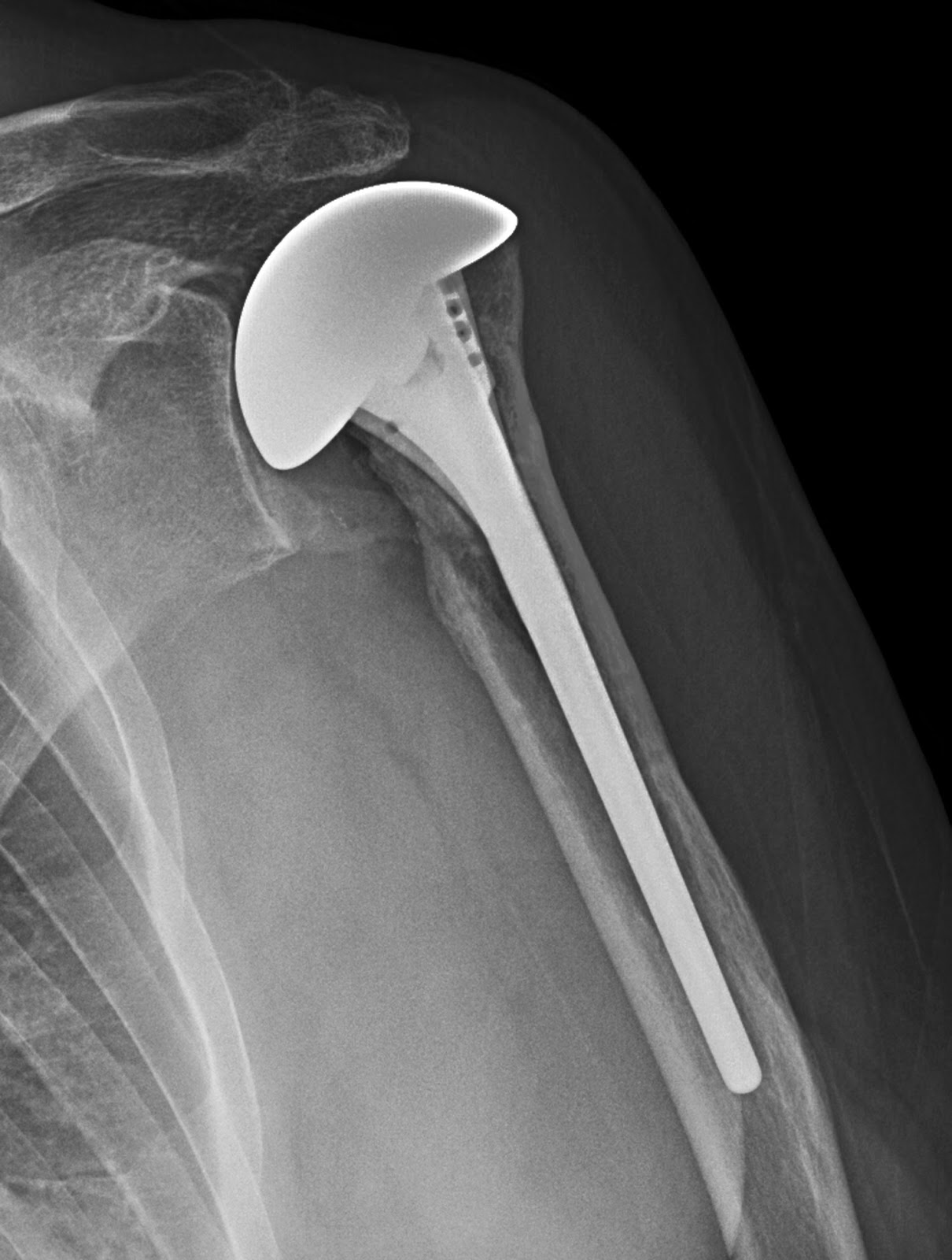 Shoulder Arthritis / Rotator Cuff Tears causes of shoulder pain