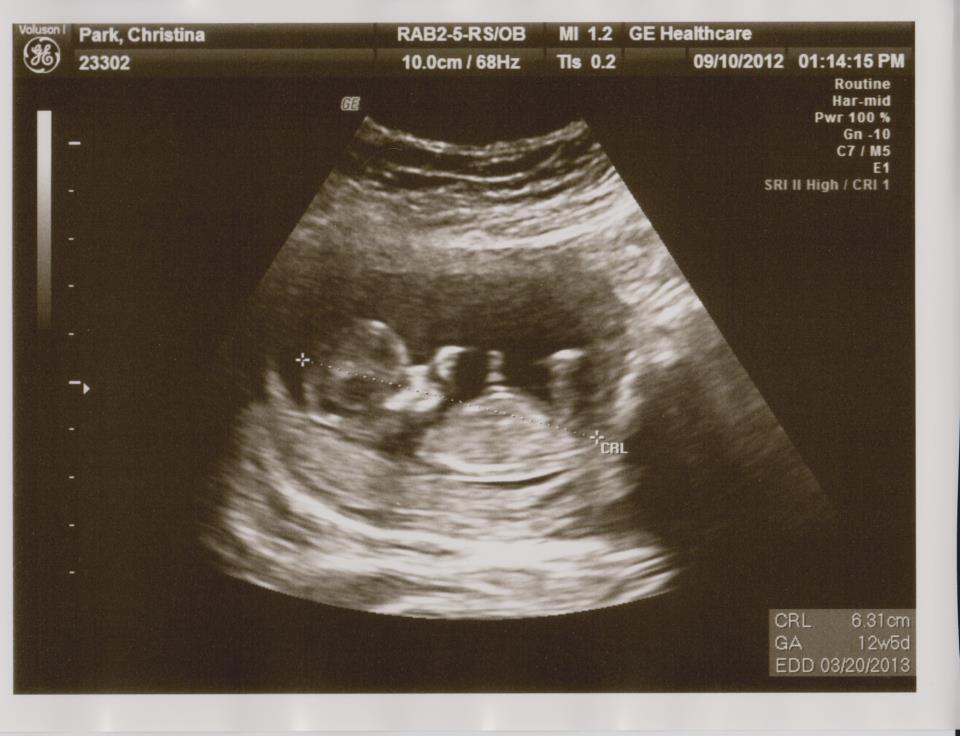 Baby holding iud ultrasound information hostalelportalico