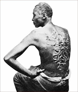 Scarred Back of an Escaped Mississippi Slave