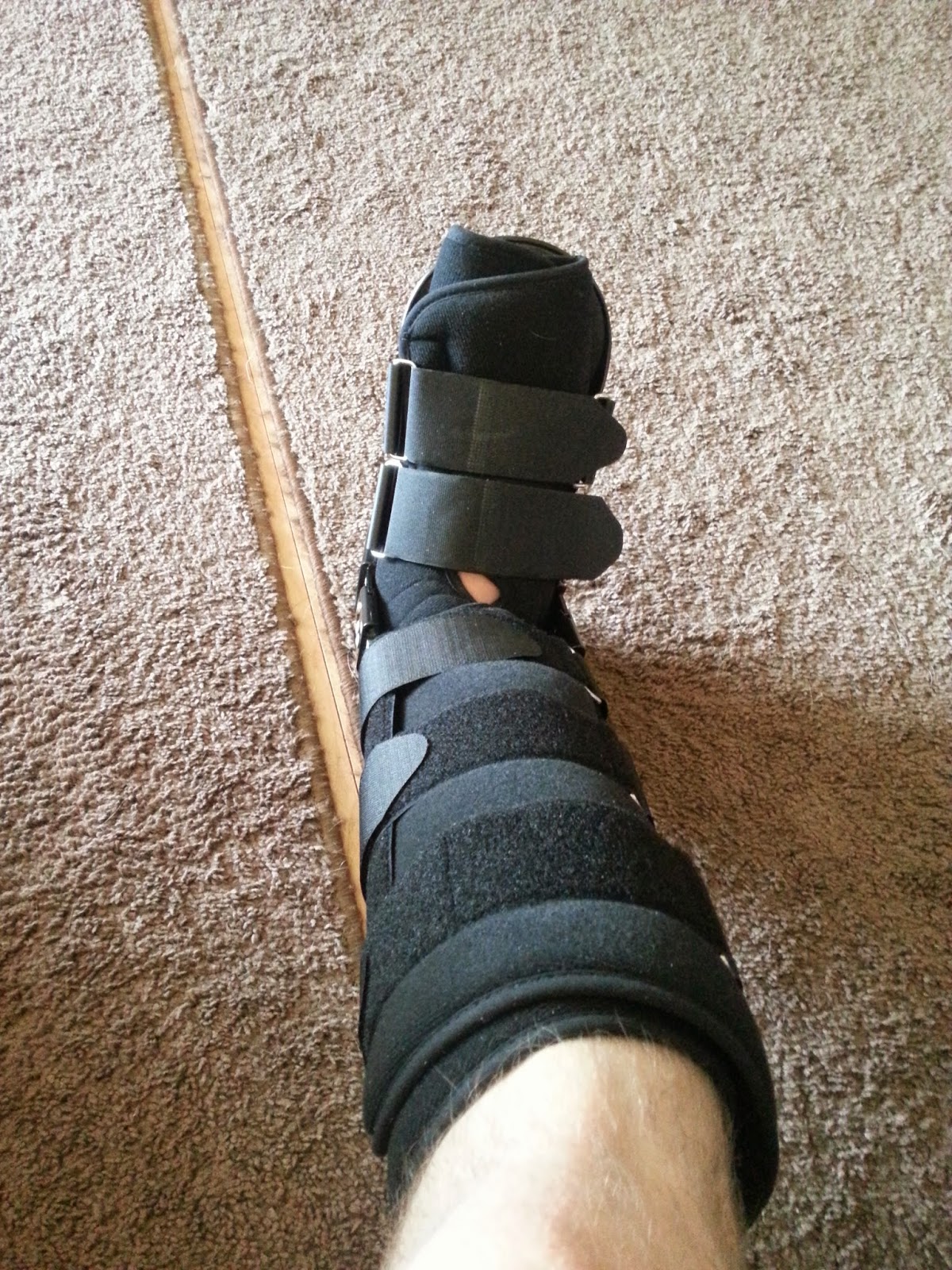 Tarsal Coalition Walking Boot and physical therapy