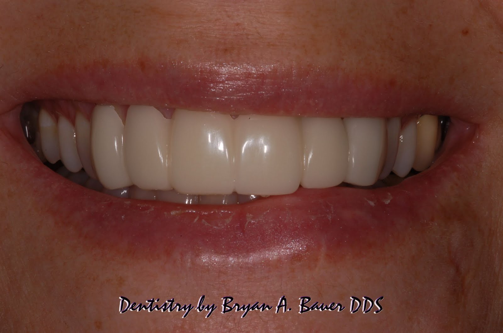 Dental flipper choices What are your options? What's cost?