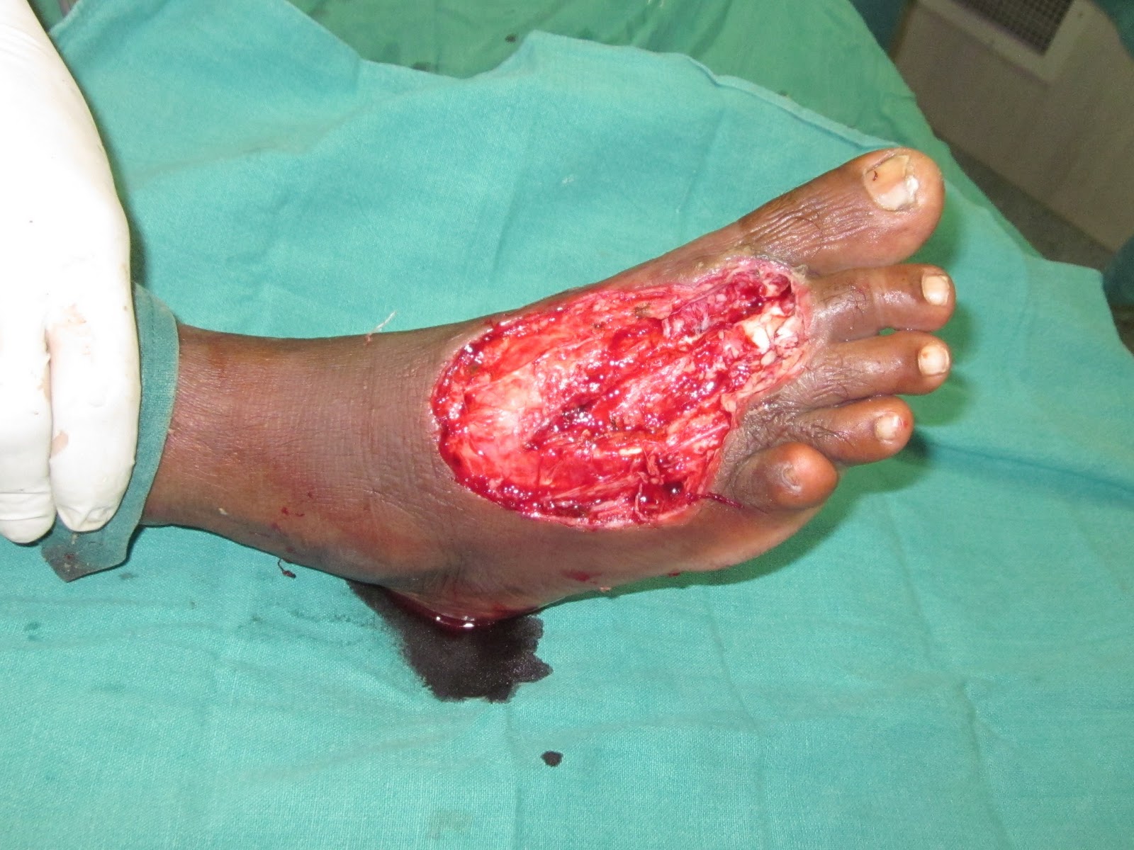 gangrene on foot