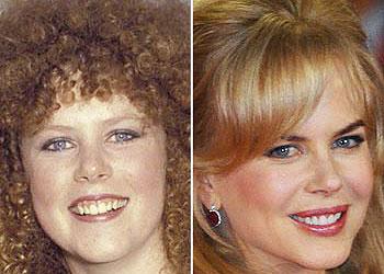 Nicole Kidman Plastic Surgery on Chatter Busy  Nicole Kidman Plastic Or Cosmetic Surgery