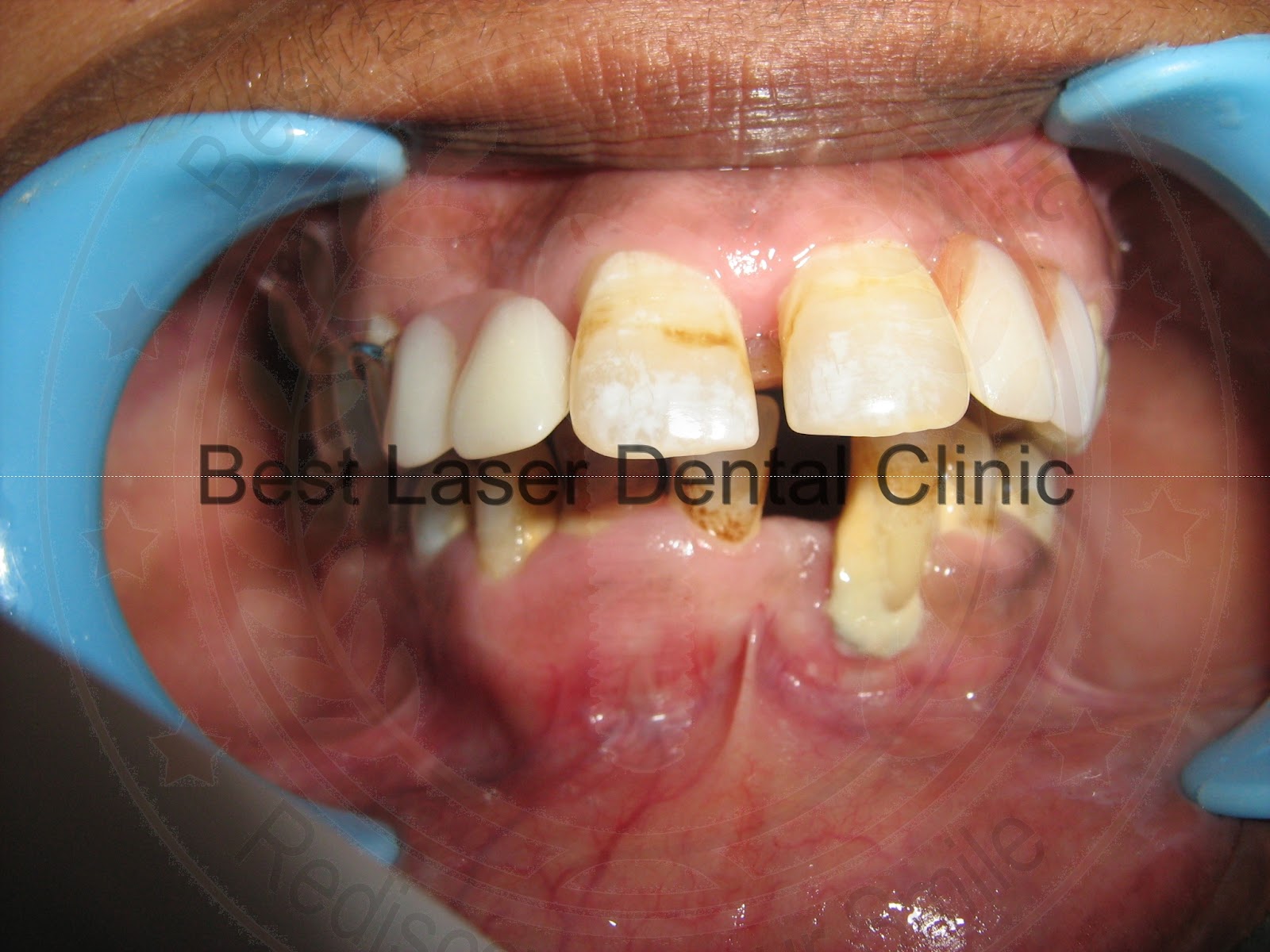 Gallery 6Immediate Dental Implant placement in a periodontaly weakened