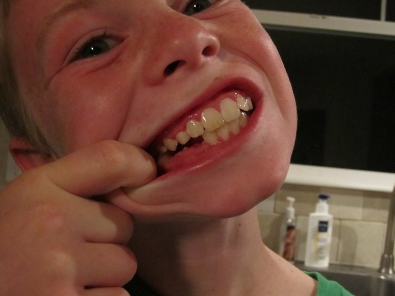 bad capped teeth