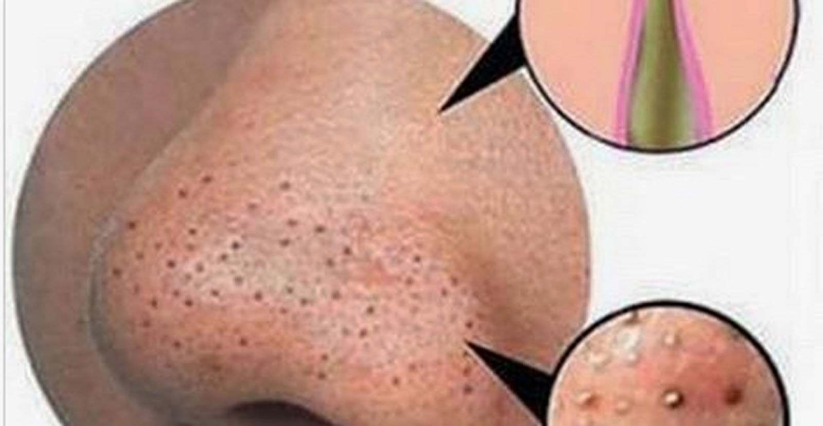 how to get rid of whiteheads and blackheads naturally discover reality how blackheads form