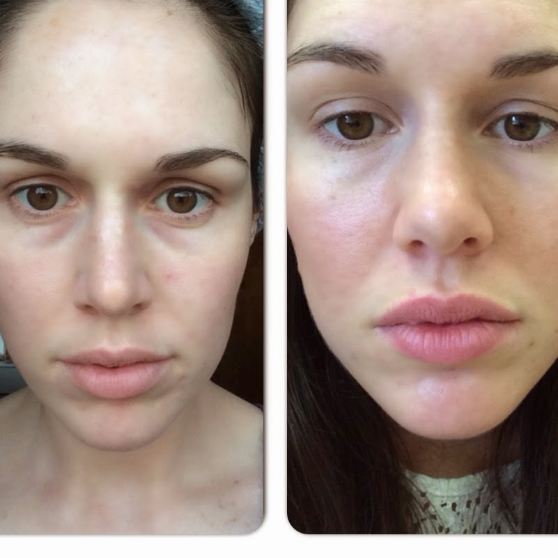 Before and after of doing a coffee mask to reduce puffiness/under eye