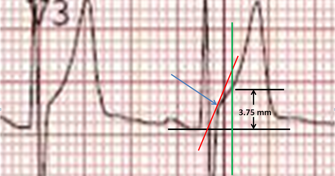 Dr. Smith's ECG Blog How to measure ST Elevation at 60 milliseconds