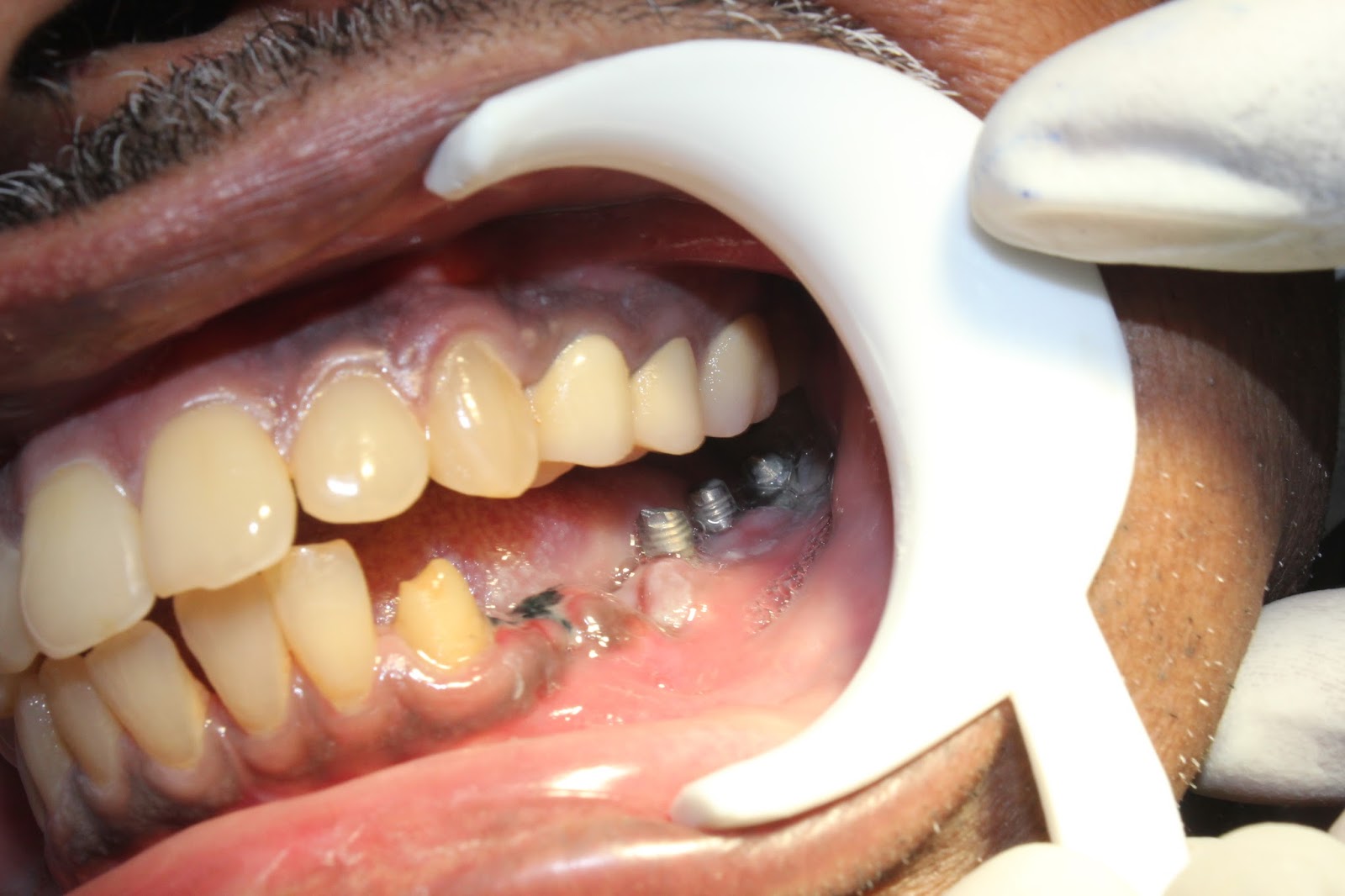 Zirconium bridges for teeth replacement with dental implants.