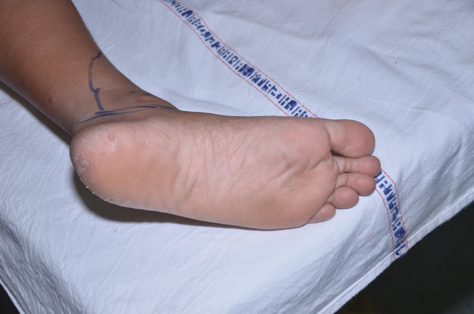 CRUSH INJURY FOOT, LOWER LIMB INJURIES AND LIMB SALVAGE ARTERIOVENOUS