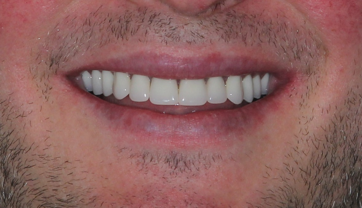 Boise Idaho Prosthodontics True Immediate Maxillary Complete Denture