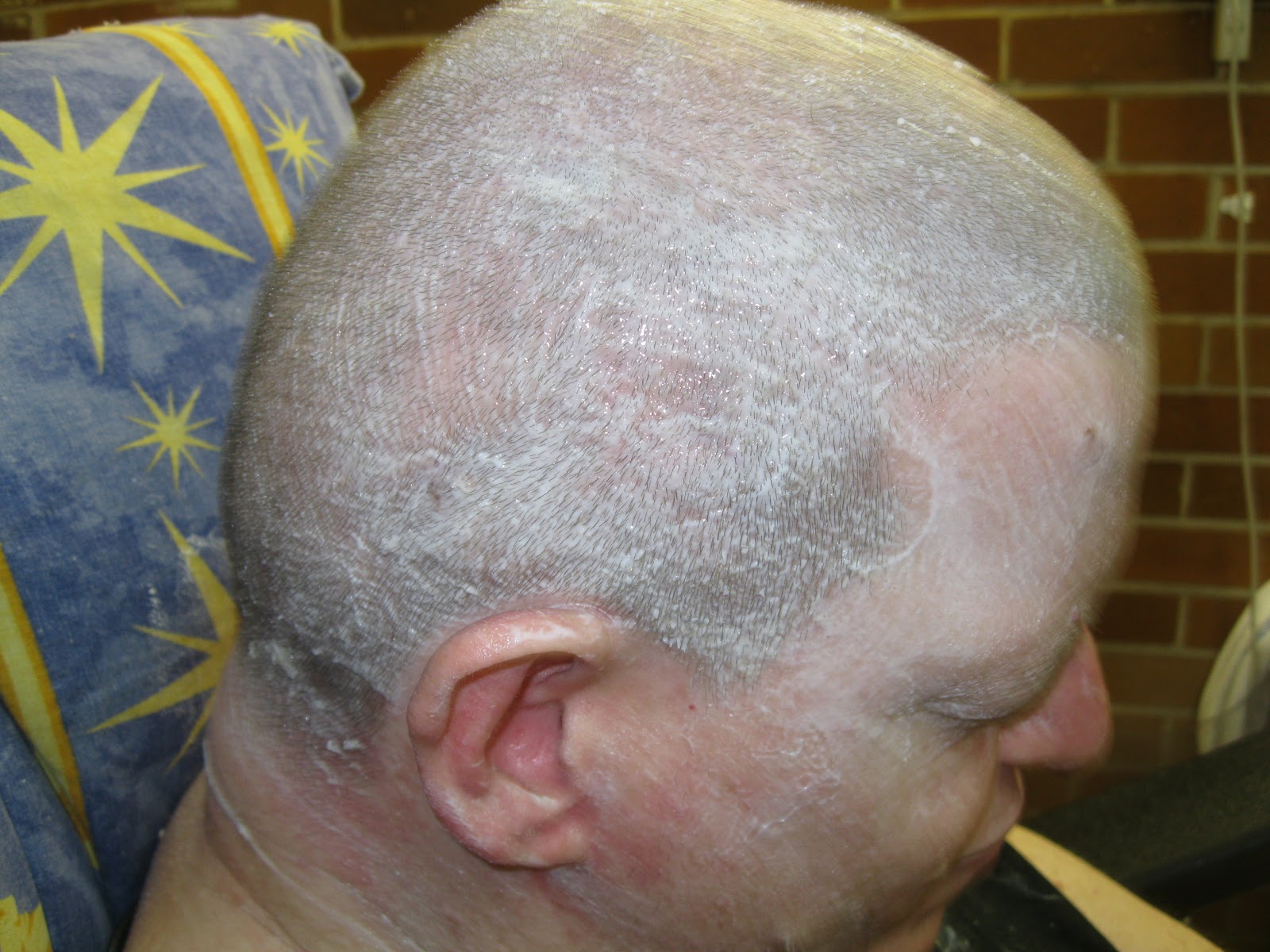 Cerebral Palsy Medical