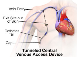 presence of foley catheter icd 10 presence of foley catheter icd 10