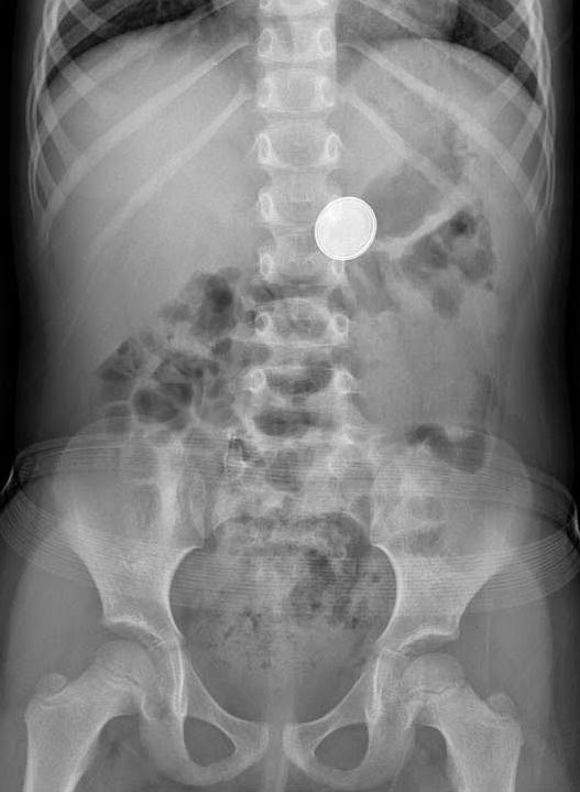 Random Rambles Button battery vs coin ingestion