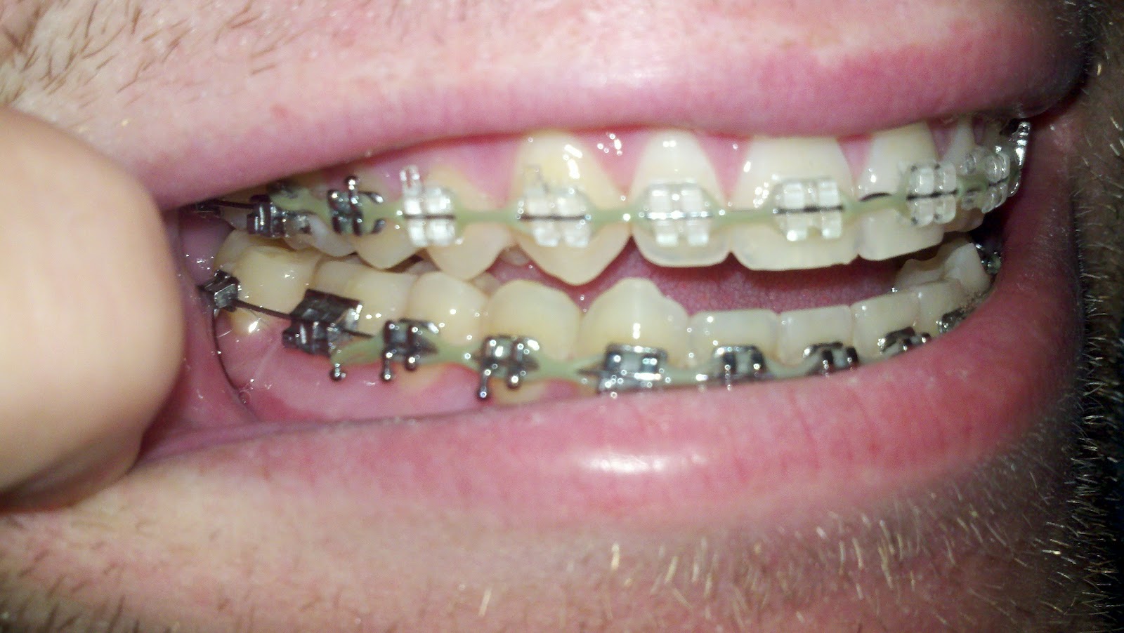 Braces/Open Bite Surgery New Pricing Info and Pics