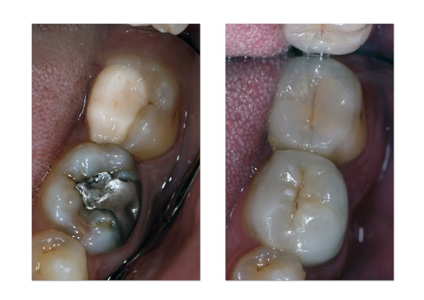 York Place Dental Blog Ceramic Fillings